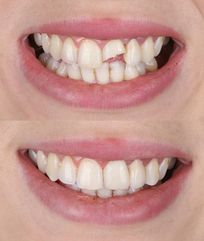 Cosmetic bonding can rebuild your broken or damaged teeth