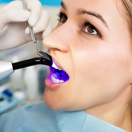 Cosmetic bonding uses tooth colored composite resin to rebuild broken teeth
