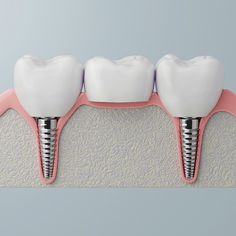 Digital illustration of dental implant bridge