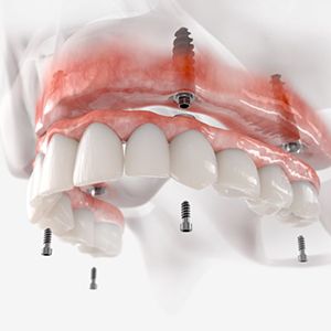 Illustration of fixed implant dentures for upper arch
