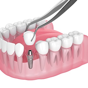 Illustration of a single dental implant