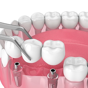 Illustration of an implant bridge