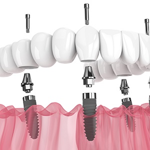 Illustration of an implant denture