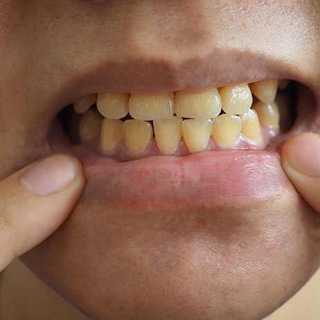 Person with yellowed teeth