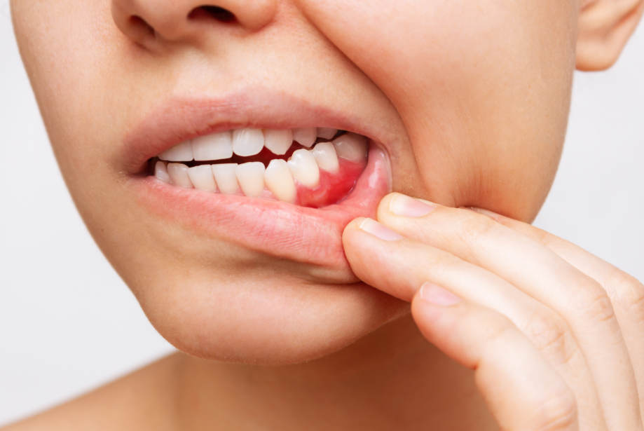 Close up of woman's mouth showing reddened gums